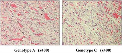 Association between Kaposi’s sarcoma-associated herpesvirus genotype and clinical types